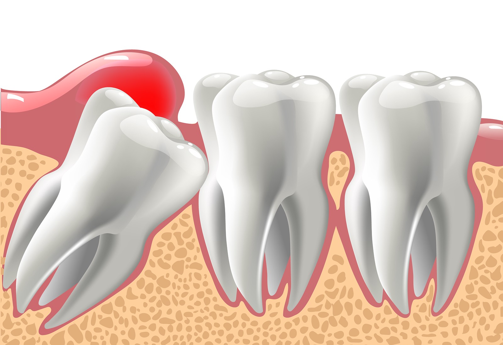 Wisdom Teeth Removal Melbourne