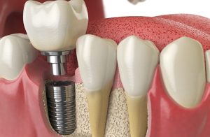 Dental Implant Treatment